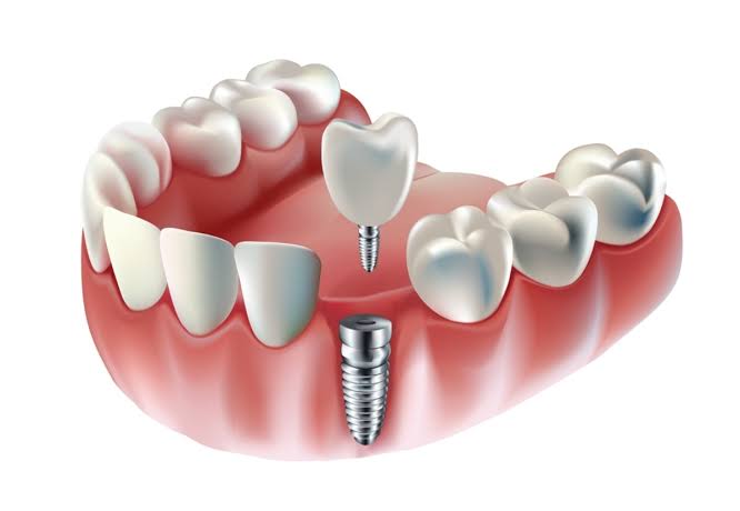 How Dental Implants Help Restore Missing Teeth Naturally