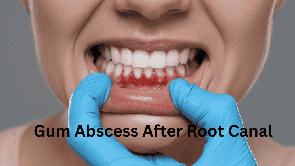 Bump on Gum After Root Canal: Causes & Treatment Guide