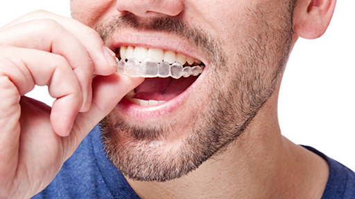 best clear braces for teeth
